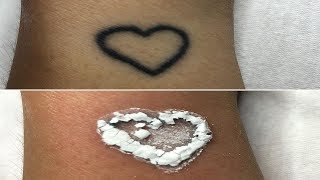 How To Remove Tattoo Naturally At Home Without Laser [upl. by Nylkoorb]