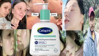 Cetaphil Pore Clearing Acne Cleanser  Honest Review [upl. by Ellehcsar803]