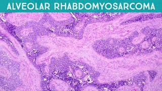 Alveolar rhabdomyosarcoma explained in 5 minutes pediatric pathology USMLE rare disease [upl. by Zanas332]