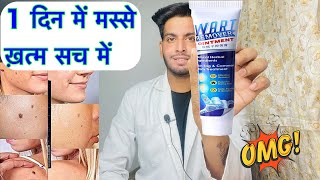 Wart removal cream review  wart removal cream  Wart removal cream uses  Wart removal cream hindi [upl. by Ondrej]