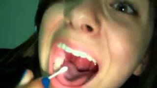 Gnarly Tonsil Stone Removal THE SEQUEL  How To ManageGet Rid Of Tonsil Stones [upl. by Taite]