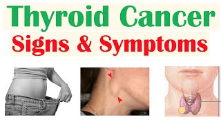 Thyroid Cancer Signs amp Symptoms amp Why They Occur [upl. by Petuu]