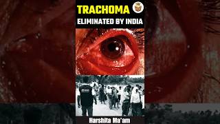 Trachoma Eliminated by India shorts [upl. by Gyatt]