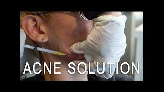 Cystic Acne Solution Kenalog Injection [upl. by Rtoip352]