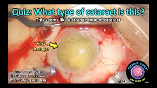 CataractCoach™ 2161 Quiz What type of cataract is this [upl. by Eugenle]