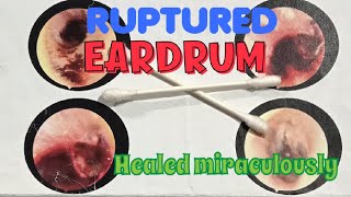 I ruptured my EARDRUM Healed in 6 months without any surgery Heres the story [upl. by Witha163]