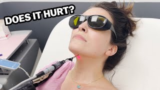 My Journey With Laser Hair Removal The Truth [upl. by Nared]