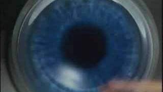 LasikPlus Intralase® Bladeless LASIK Procedure AllLaser Lasik [upl. by Faith]