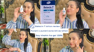 Dalacin T Lotion Review Bye bye Acne 😡 say Hi to new skin❤️Best Acne lotion 100 guaranteed results [upl. by Marchall]