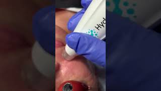 Hydra Pen Facial [upl. by Maurice985]