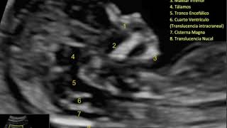 Ecografía Morfológica en Primer Trimestre Todo lo que se debe evaluar en un corte sagital alto [upl. by Vershen825]