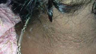 what are disease associated with acanthosis nigricans [upl. by Eahcim]