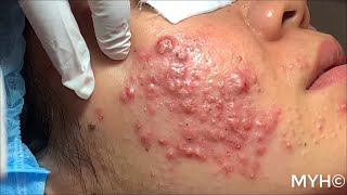 Cystic Pustules Acne Extractions EP14 No Clickbait [upl. by Reinhardt]