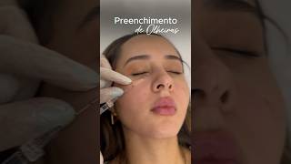 Preenchimento para olheiras 👀 harmonizacaofacial tratamentofacial [upl. by Harrietta8]