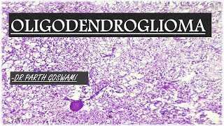 Oligodendroglioma [upl. by Neras]