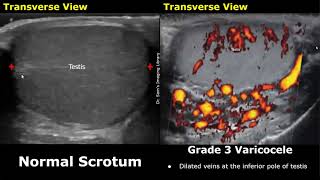 Varicocele Grading On Color Doppler Ultrasound  Grade 15 Varicocele  Scrotum amp Testis USG [upl. by Airreis]