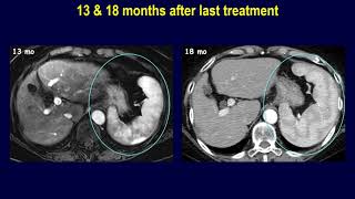 Spleen lymphomas presented as splenomegaly during FU of cirrhosis amp extrahepatic malignancy [upl. by Ahsirtal]