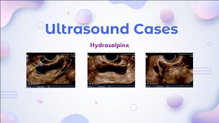 Hydrosalpinx  Ultrasound Cases [upl. by Milda953]