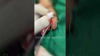 Pyogenic Granuloma Treatment Performed by Dr Arun Panda  Expert Facial Plastic Surgeon [upl. by Kailey795]