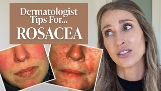 Dermatologist’s Guide to Rosacea What Is It Dos amp Don’ts Treatment Tips amp More  Dr Sam Ellis [upl. by Mobley]