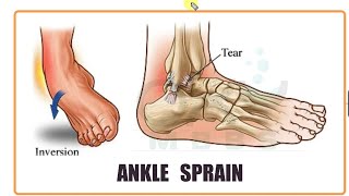 ORTHOPAEDICS Ankle Sprain [upl. by Wilkinson]