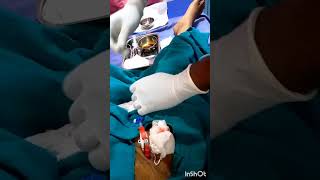 hemodialysis femoral line done youtubeshort emergency hospital [upl. by Yuri]