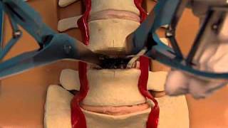 Synthes Spine ProDiscL Lumbar Total Disc Replacement Demonstration Video [upl. by Ynattirb11]