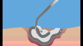 Cutimed Cavity absorption [upl. by Noyr]