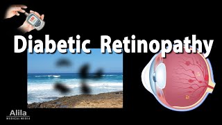 Retinopathy Diabetic and Hypertensive Animation [upl. by Nomael591]