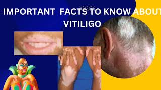 vitiligopart2diagnosis and latest treatment about opzelura creamskinhealthvitality5959 [upl. by Aiduan]