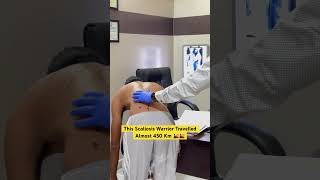 A Very Rare Scoliosis treatment by DrRavi scoliosistreatment spine chiropractic chiro sciatica [upl. by Parrie298]