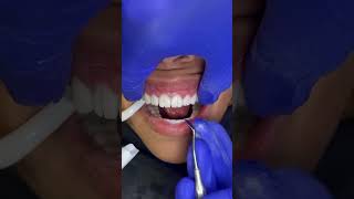 Breaking away temporary smile on revision case dentist dentistry veneers [upl. by Llerrah]