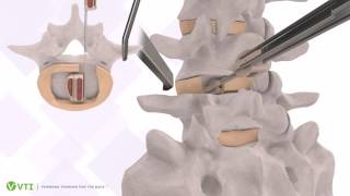 VTI InterFuse S™ Surgical Technique [upl. by Attenyl]