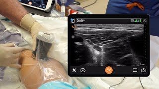 ACL Block 3  Adductor Canal Catheter [upl. by Rednijar]