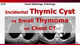 Incidental Thymic Cyst vs Small Thymoma CT [upl. by Kurtzman]