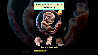 How Folic Acid Deficiency Leads to Neural Tube Defects in Pregnancy shortsviral pregnancy vitamin [upl. by Hitoshi645]