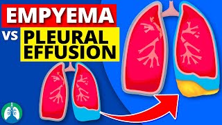 Empyema vs Pleural Effusion EXPLAINED [upl. by Enrico]