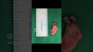 Spine tumor surgery  Neurofibroma  Intradural Extramedullary  Laminectomy [upl. by Comethuauc939]