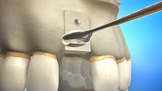 Bone Grafting Procedure Video Animation  Durham Dental Solutions [upl. by Ainahs]