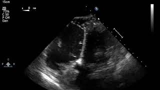 TEE deep transgastric 0 degrees LVOT view Example 1 [upl. by Shanta931]