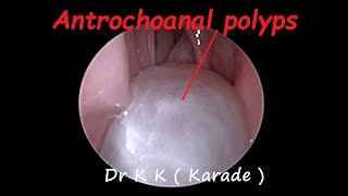 Rhinology  Huge Antrochoanal  AC  polyps [upl. by Nylareg]