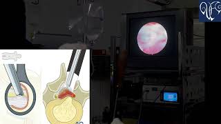 endoscopic discectomy  endoscopic spine surgery ILED Intralaminar lumbar endoscopic discectomy [upl. by Akeemahs361]