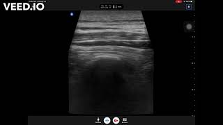 Bilateral erector spinae plane ESP block at T4 level for thoracic fusion surgery [upl. by Siol273]