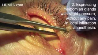 Occluded meibomian glands Expressing under local anaesthesia Dr Aral  Cologne [upl. by Doralynn]