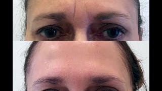 Forehead  Glabella quot11quot Rejuvenation with Botox and Restylane [upl. by Hedva]