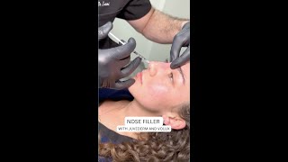 Nose Filler with Juvederm and Volux [upl. by Clance]