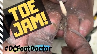 Trimming Fungal Toenails Corns Calluses and Toe Jam Problems of an At Risk Diabetic [upl. by Charyl916]