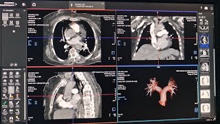 ANGIOTEP con bolus tracking SIEMENS SOMATON Go 64 cortes [upl. by Vizza]