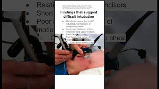 Findings that suggest difficult intubation [upl. by Ariam]