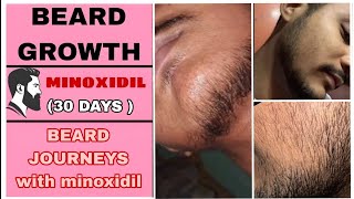 BEARD GROWTH  IN JUST 30 DAYS WITH THE HELP OF MINOXDIL 5 [upl. by Ehcnalb]